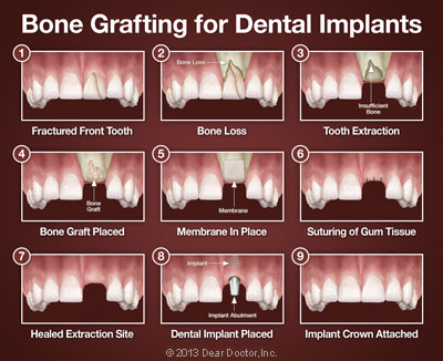 bone-grafting-for-dental-implants