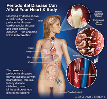 gum-disease-can-affect-body-thumb