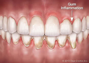 gum-inflammation