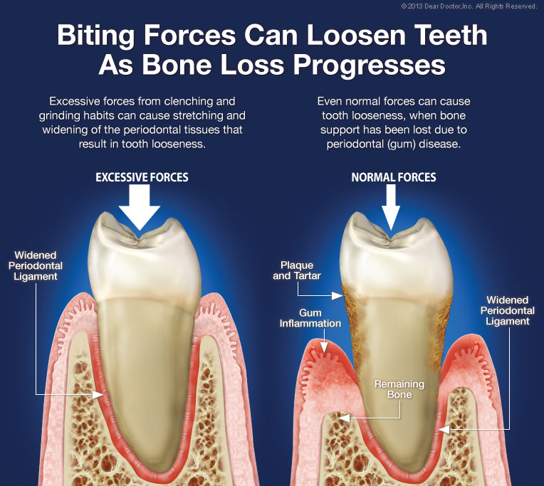 loose tooth