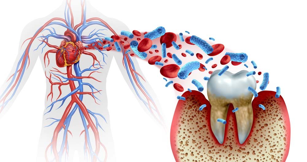 perio gum disease