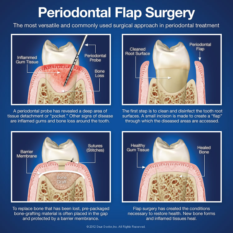 periodontal-flap-surgery